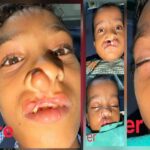 चिरायु योजना से जन्मजात समस्या से मिली राहत, तीन बच्चों के चेहरों पर लौटी मुस्कान